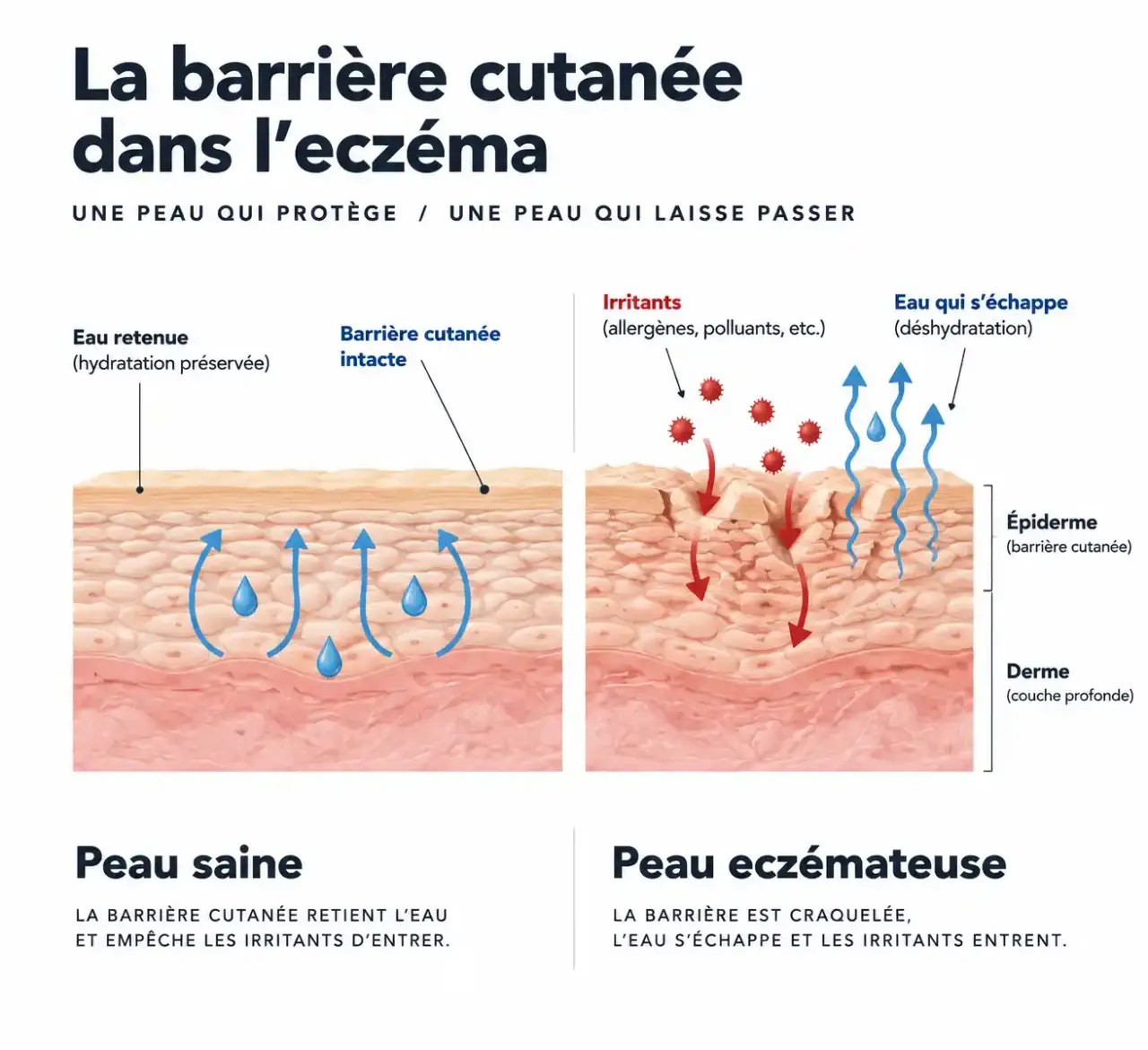 Schéma de la barrière cutanée dans l'eczéma : pourquoi l'homéopathie et les démangeaisons ne dispensent pas d'hydrater la peau